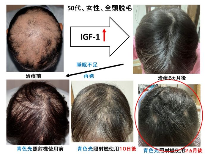 円形脱毛症　病院